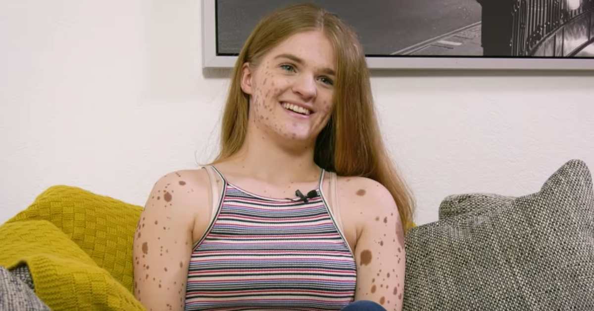 Young girl bullied for birthmarks all over her body then a modeling